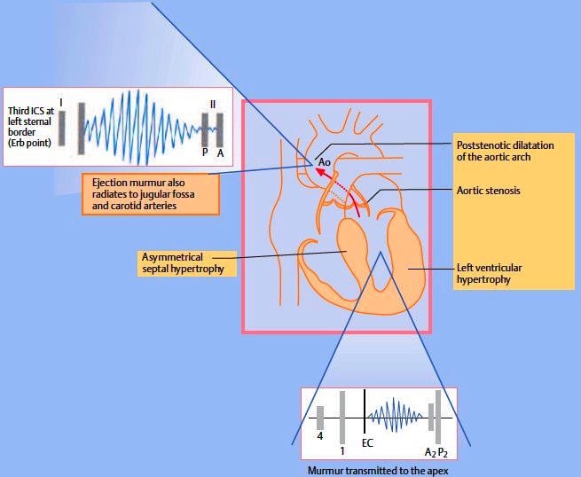 Aortic Stenosis. Symptoms and Signs of Aortic Stenosis